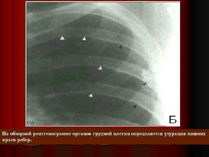 На обзорной рентгенограмме органов грудной клетки определяется узурация нижних краев ребер. 