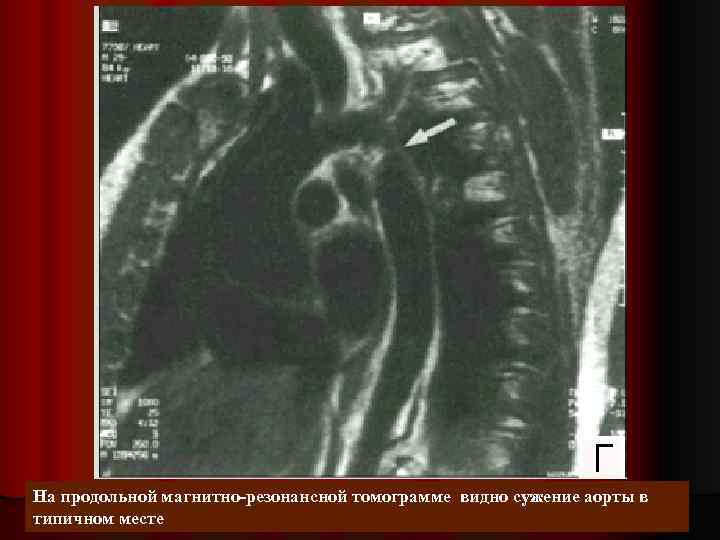 На продольной магнитно-резонансной томограмме видно сужение аорты в типичном месте 