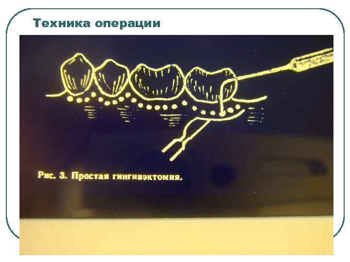 Техника операции 