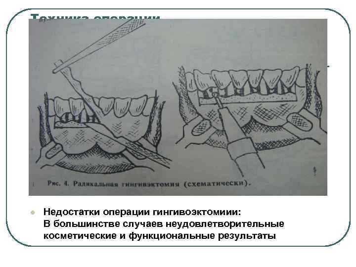 Техника операции l Недостатки операции гингивоэктомиии: В большинстве случаев неудовлетворительные косметические и функциональные результаты