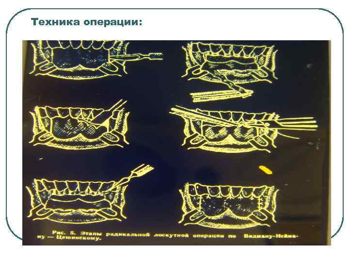 Техника операции: 