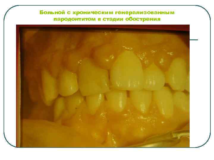 Больной с хроническим генерализованным пародонтитом в стадии обострения 