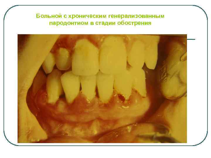 Больной с хроническим генерализованным пародонтиом в стадии обострения 