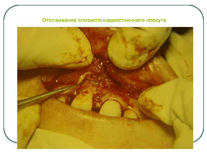 Отслаивание слизисто-надкостничного лоскута 