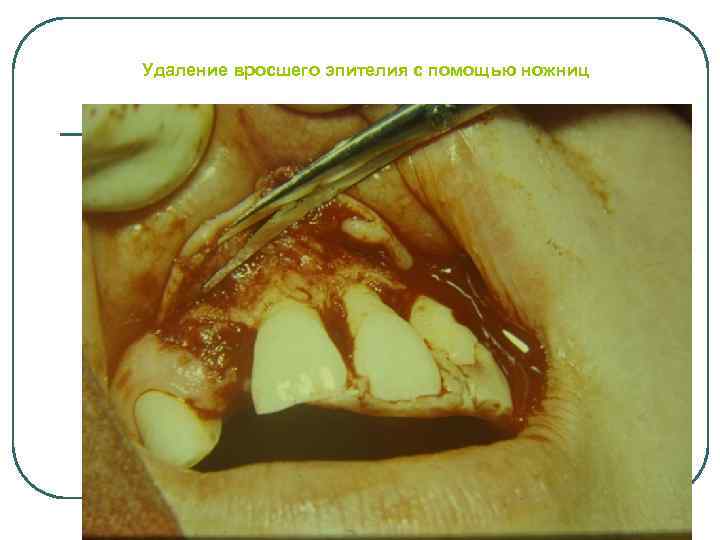 Удаление вросшего эпителия с помощью ножниц 