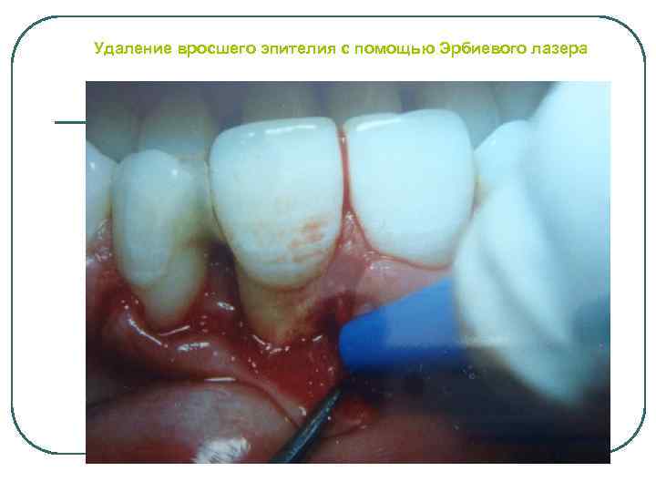 Удаление вросшего эпителия с помощью Эрбиевого лазера 