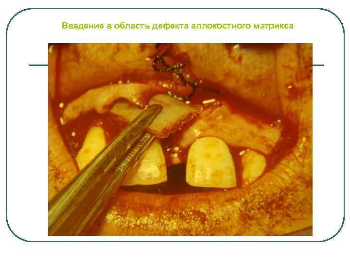 Введение в область дефекта аллокостного матрикса 