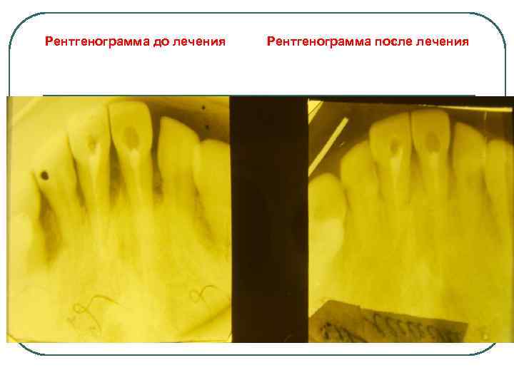 Рентгенограмма до лечения Рентгенограмма после лечения 