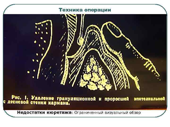 Техника операции Недостатки кюретажа: Ограниченный визуальный обзор 