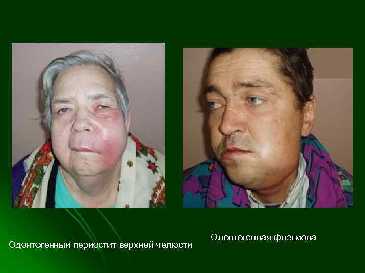  Одонтогенная флегмона Одонтогенный периостит верхней челюсти 