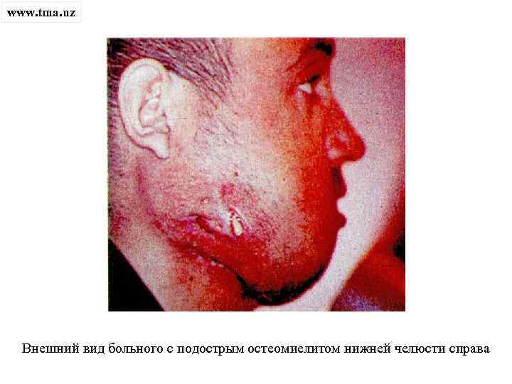 www. tma. uz Внешний вид больного с подострым остеомиелитом нижней челюсти справа 