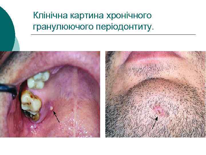 Клінічна картина хронічного гранулюючого періодонтиту. 