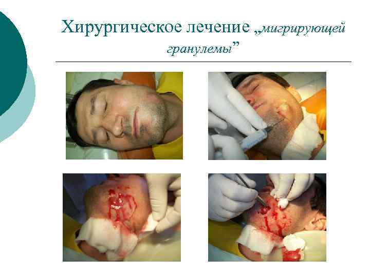 Хирургическое лечение „мигрирующей гранулемы” 