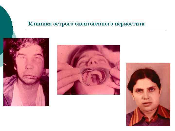 Клиника острого одонтогенного периостита 