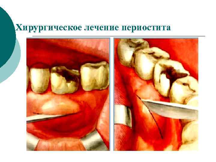 Периостит зуба фото