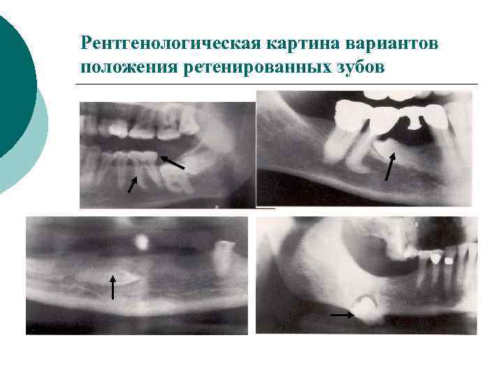 Периостит клиническая картина