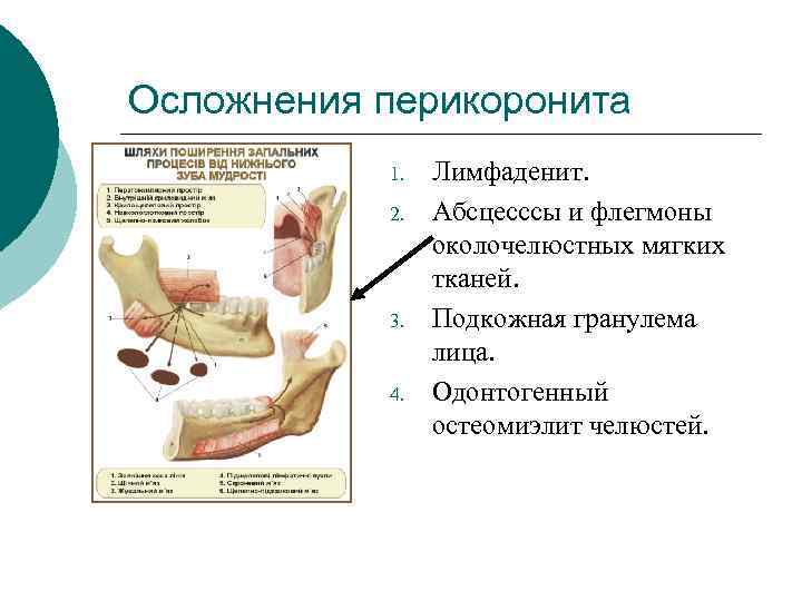 Осложнения перикоронита 1. 2. 3. 4. Лимфаденит. Абсцесссы и флегмоны околочелюстных мягких тканей. Подкожная