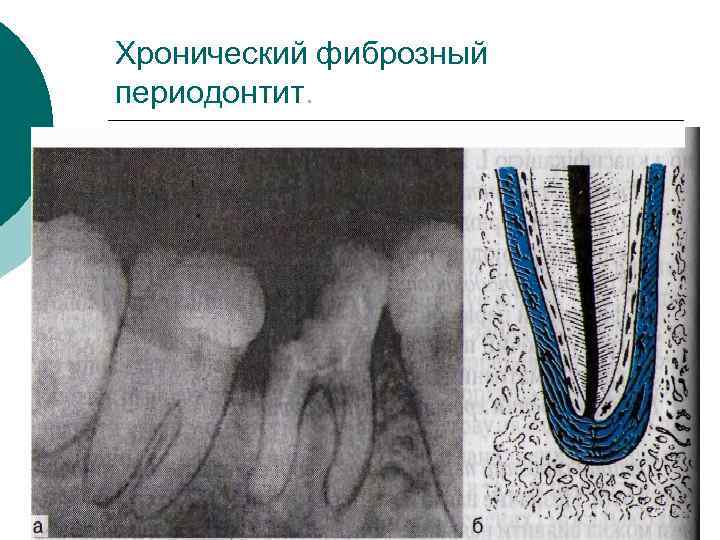 Хронический фиброзный периодонтит. 