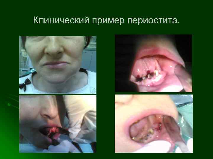 Клинический пример периостита. 