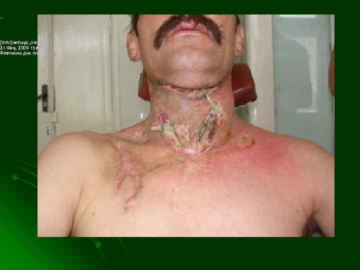 [info]nemaya_ovcharka wrote: 21 Фев, 2009 15: 08 (UTC) Флегмона дна полости рта и