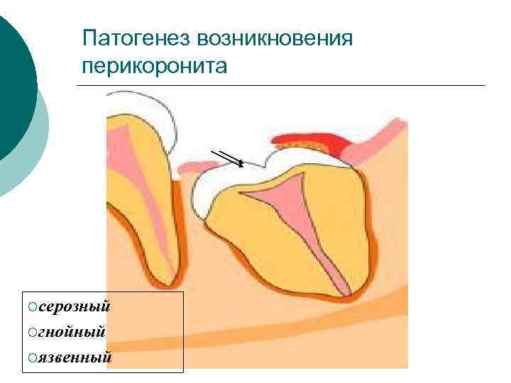 Этиология острого периодонтита. Острый Гнойный Гнойный периостит. Патогенез Гнойного периостита. Периостит этиология. Острый серозный периостит.