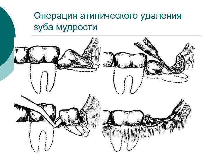 Удалить восьмерку. Резекция зубов верхней челюсти. Схема выдергивания зуба. Вырывание зуба мудрости.