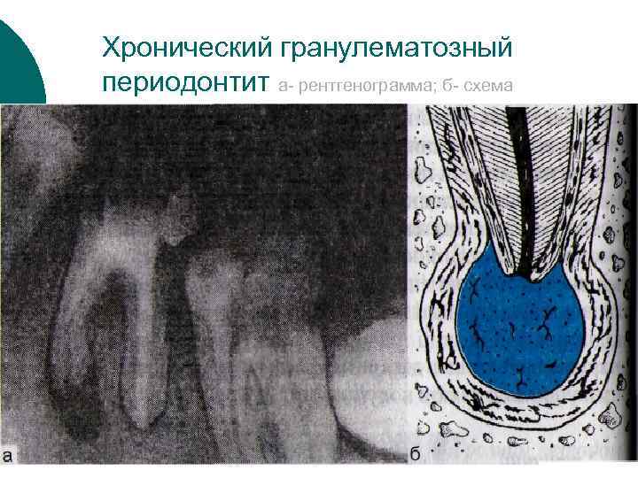 Хронический фиброзный периодонтит мкб. Хронический гранулематозный апикальный периодонтит. Хронический гранулирующий периодонтит рентгенограмма. Гранулематозный периодонтит в обострении. Острый серозный периодонтит рентген.