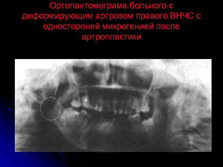 Ортопантомограма больного с деформирующим артрозом правого ВНЧС с одностороней микрогенией после артропластики 