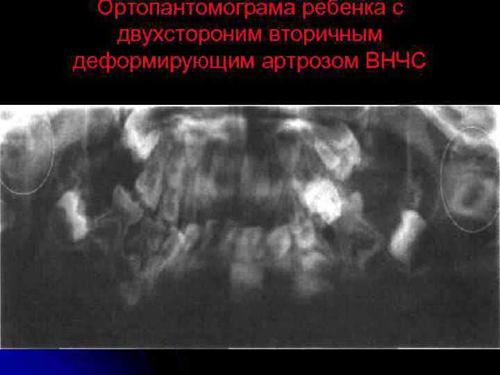Ортопантомограма ребенка с двухстороним вторичным деформирующим артрозом ВНЧС 