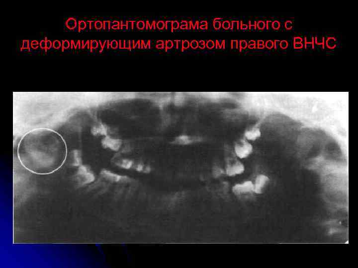 Ортопантомограма больного с деформирующим артрозом правого ВНЧС 
