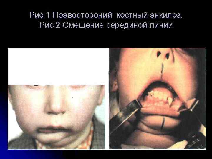 Рис 1 Правостороний костный анкилоз. Рис 2 Смещение серединой линии 