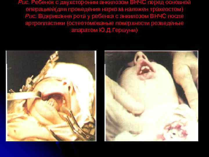 Рис. Ребенок с двухстороним анкилозом ВНЧС перед основной операцией(для проведения наркоза наложен трахеостом) Рис.