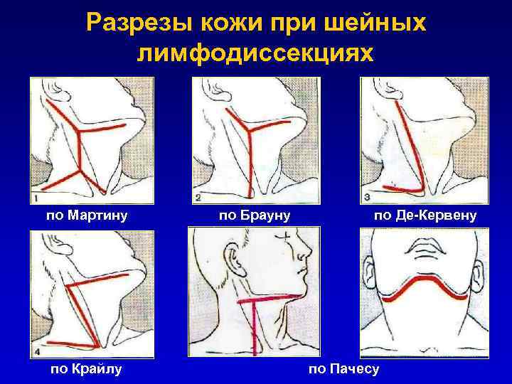 Разрезы кожи при шейных лимфодиссекциях по Мартину по Брауну по Де-Кервену по Крайлу по