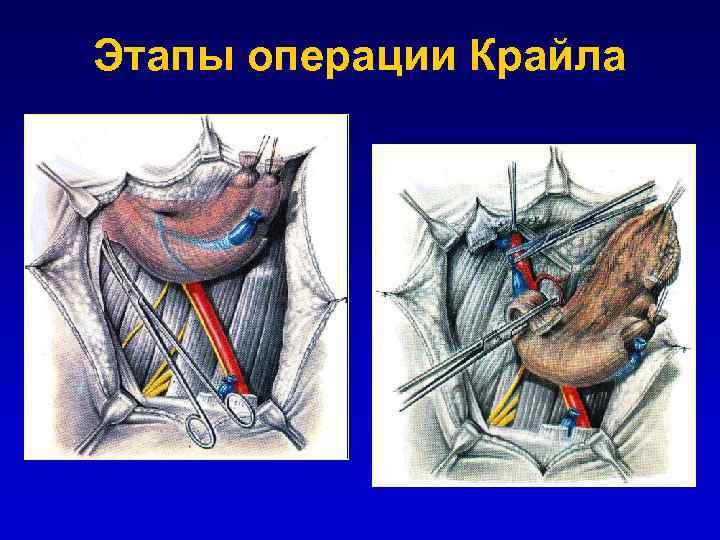 Этапы операции Крайла 