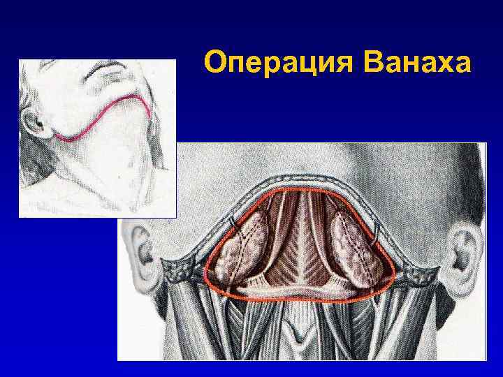 Операция Ванаха 