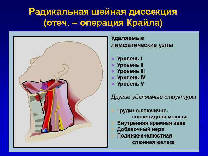 Цервикобрахиалгия справа на фоне шейного