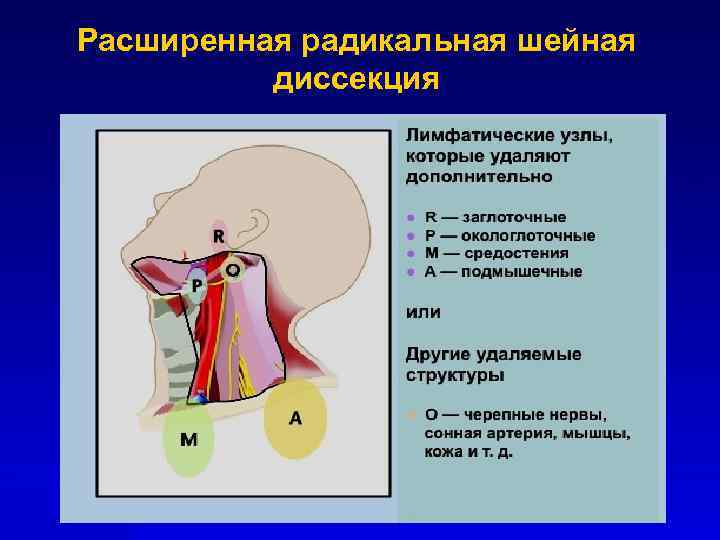 Расширенная радикальная шейная диссекция 