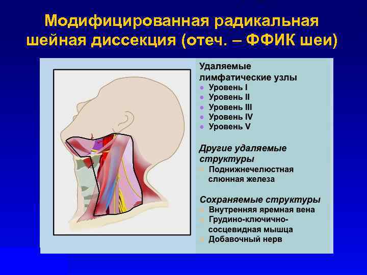 Модифицированная радикальная шейная диссекция (отеч. – ФФИК шеи) 