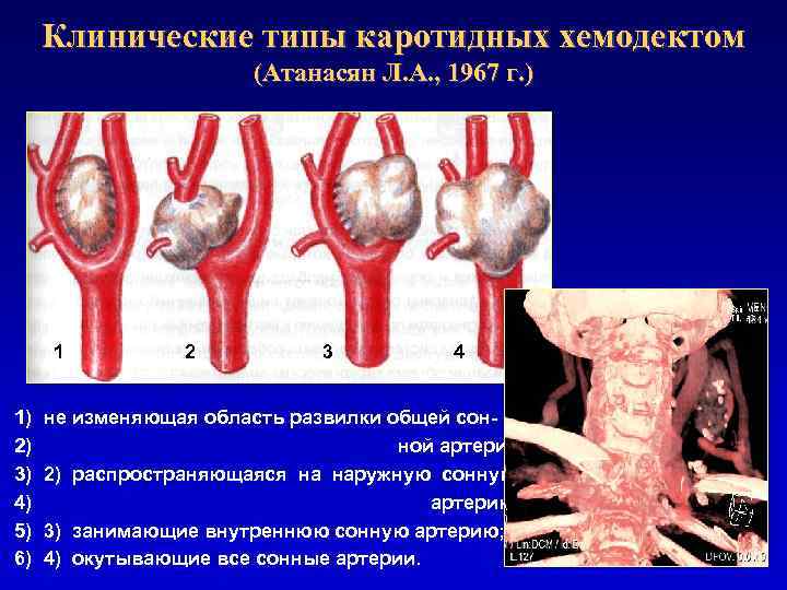 Клинические типы каротидных хемодектом (Атанасян Л. А. , 1967 г. ) 1 1) 2)