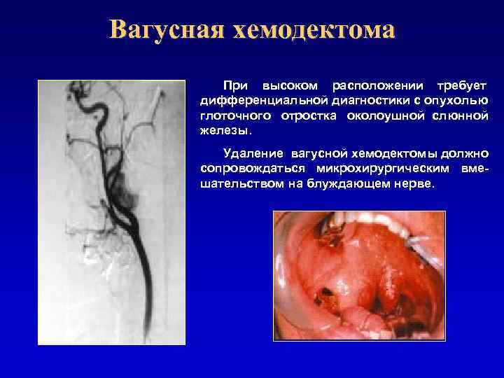 Вагусная хемодектома При высоком расположении требует дифференциальной диагностики с опухолью глоточного отростка околоушной слюнной