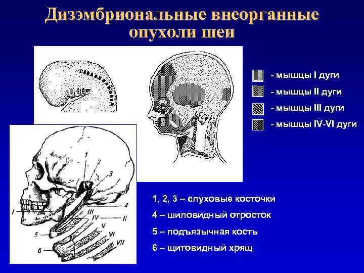 Дизэмбриональные внеорганные опухоли шеи - мышцы I дуги - мышцы III дуги - мышцы