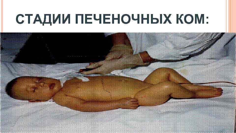 СТАДИИ ПЕЧЕНОЧНЫХ КОМ: 