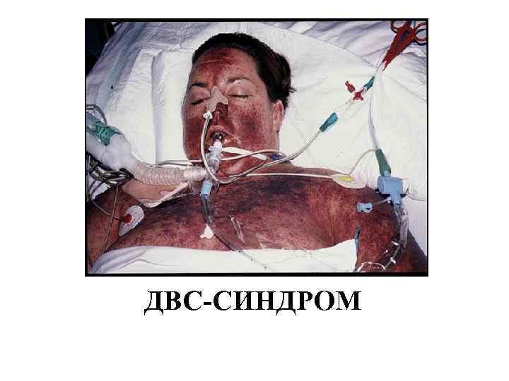 ДВС-СИНДРОМ 