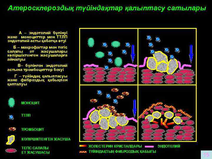 Атеросклероздық түйіндақтар қалыптасу сатылары А Б В А – эндотелий бүлінуі және моноциттер мен