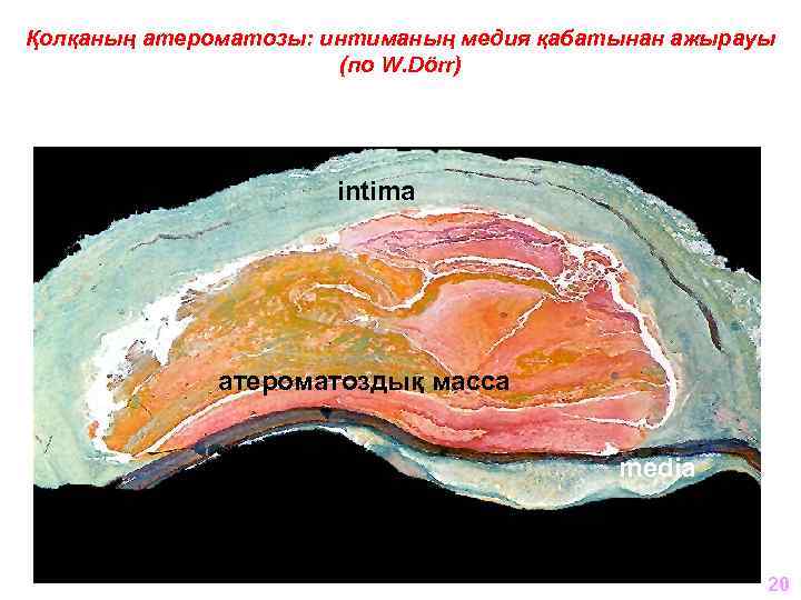 Қолқаның атероматозы: интиманың медия қабатынан ажырауы (по W. Dörr) intima атероматоздық масса media 20