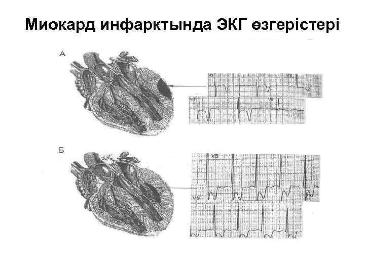 Миокард инфарктында ЭКГ өзгерістері 