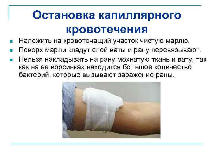 Остановка капиллярного кровотечения n n n Наложить на кровоточащий участок чистую марлю. Поверх марли