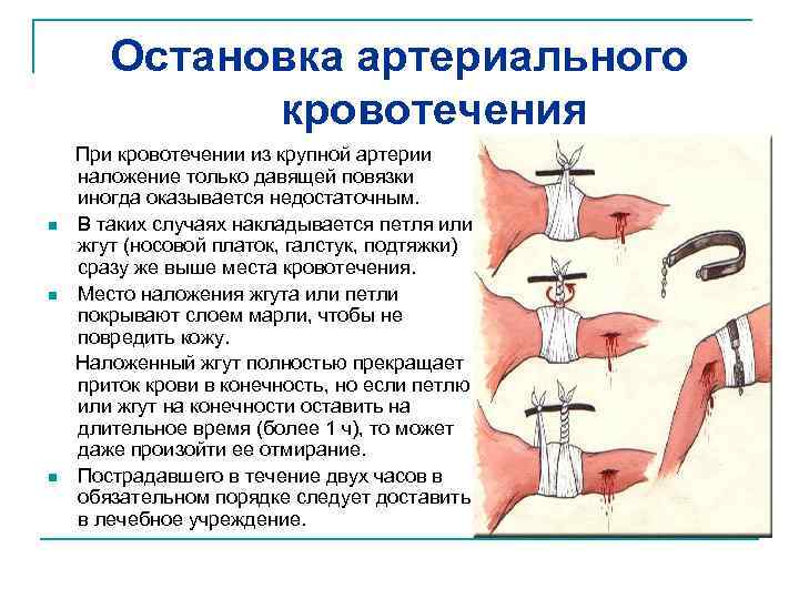 Остановка артериального кровотечения При кровотечении из крупной артерии наложение только давящей повязки иногда оказывается