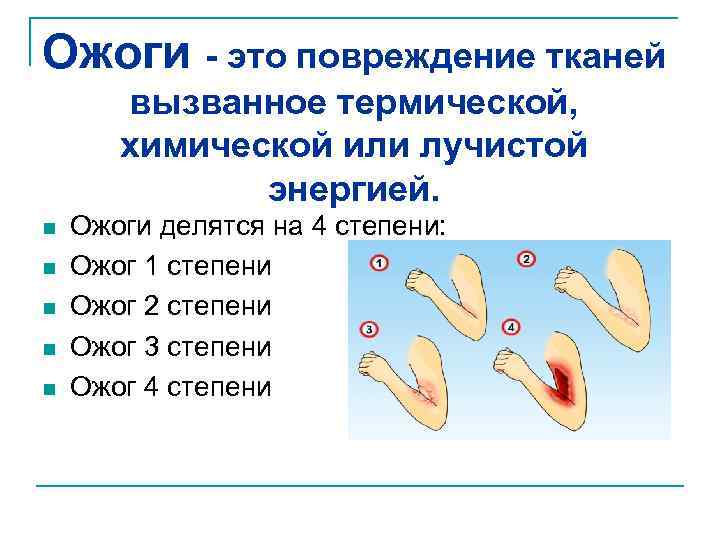 Ожоги - это повреждение тканей вызванное термической, химической или лучистой энергией. n n n