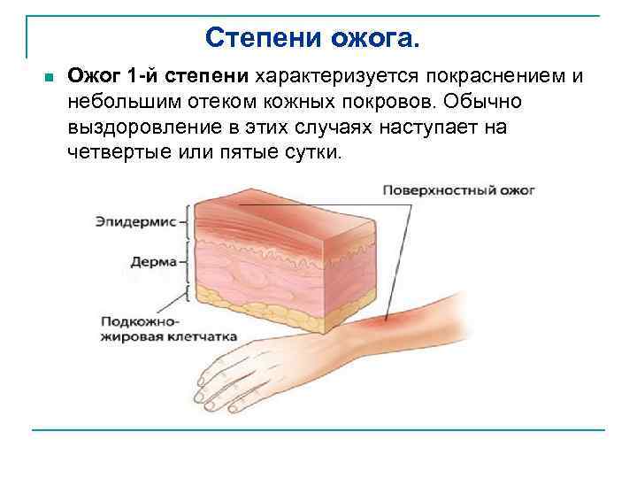 Степени ожога. n Ожог 1 -й степени характеризуется покраснением и небольшим отеком кожных покровов.